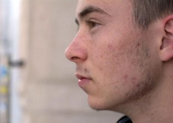 acne-treatment-in-ayurveda-sreepathy-ayurvedam