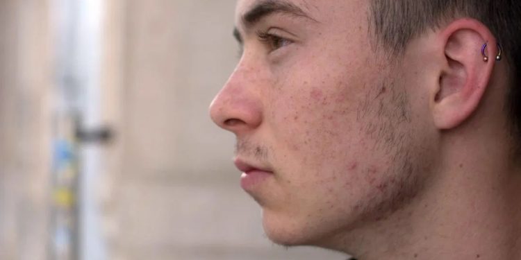 acne-treatment-in-ayurveda-sreepathy-ayurvedam