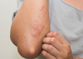 chronic skin diseases treatments in ayurveda