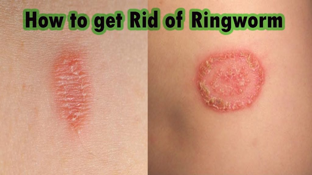RingWorm Sreepathy Ayurveda